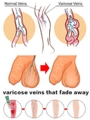 Pomada para varizes Elimina as veias da aranha para aliviar a vasculite flebite Tratamento da dor da aranha Varizes