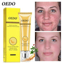 Tratamento de Acne Remoção de Cravo Creme Anti-Acne Controle de Oleosidade Diminuir Poros Cicatriz de Acne Remover Cicatrizes de Rosto Clareamento