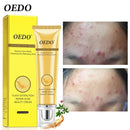 Tratamento de Acne Remoção de Cravo Creme Anti-Acne Controle de Oleosidade Diminuir Poros Cicatriz de Acne Remover Cicatrizes de Rosto Clareamento