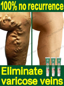 Pomada para varizes Elimina as veias da aranha para aliviar a vasculite flebite Tratamento da dor da aranha Varizes